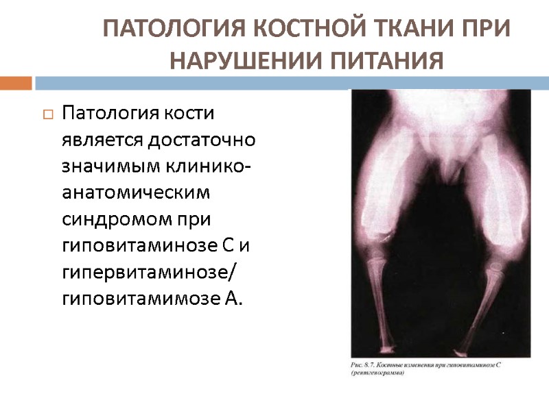 ПАТОЛОГИЯ КОСТНОЙ ТКАНИ ПРИ НАРУШЕНИИ ПИТАНИЯ   Патология кости является достаточно значимым клинико-анатомическим